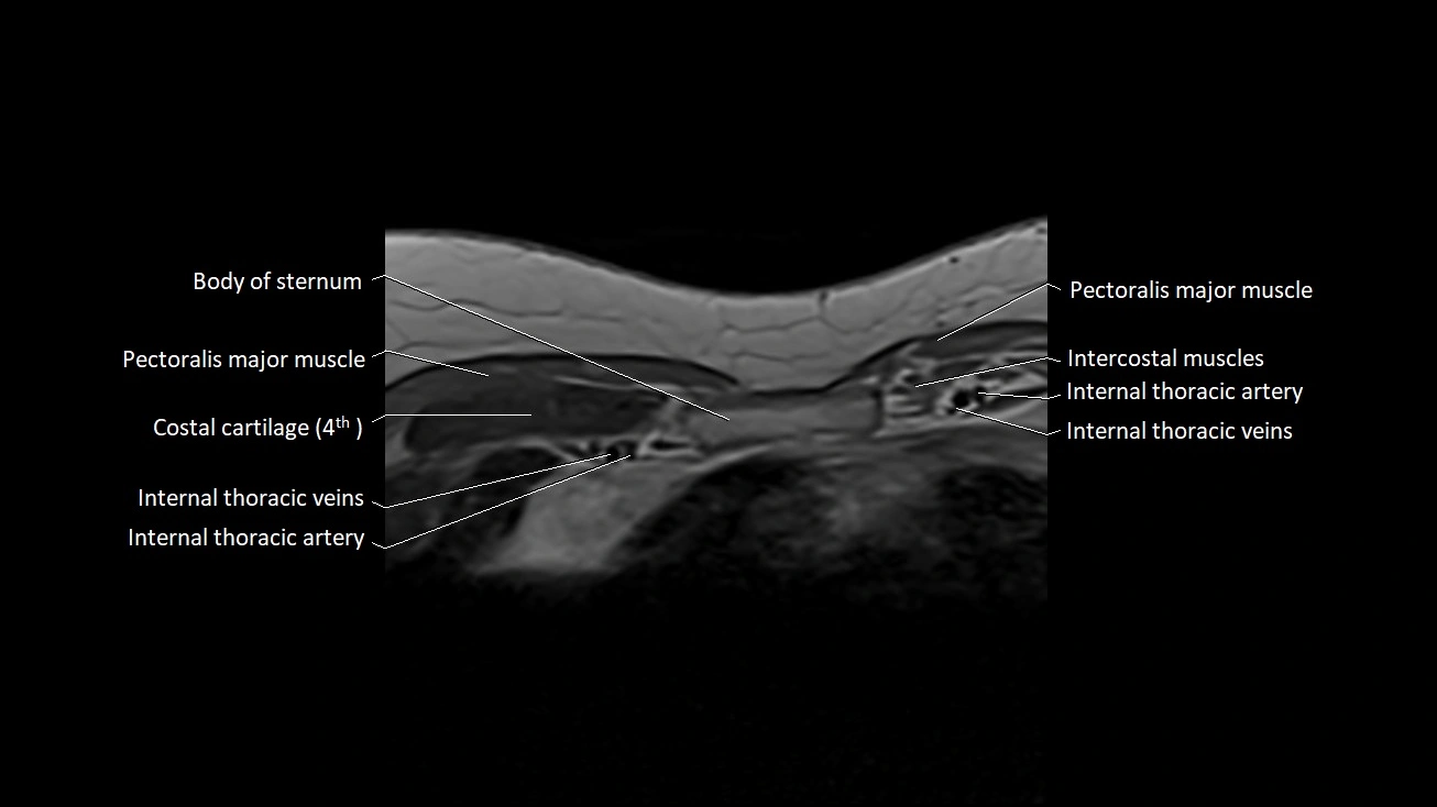 MRI sternum and sternoclavicular joint labeled axial anatomy image 26.webp